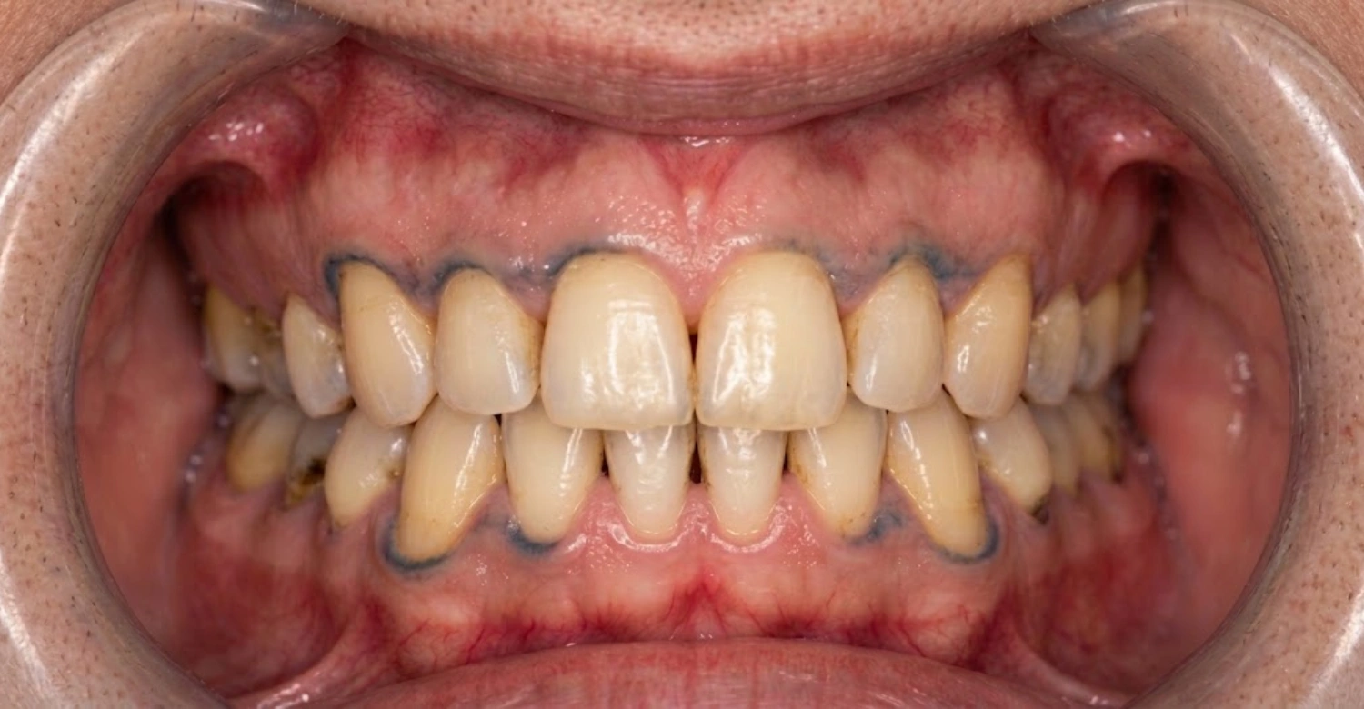 Lead poisoning teeth line3